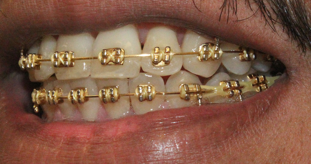 Gold braces in action Sugar Land