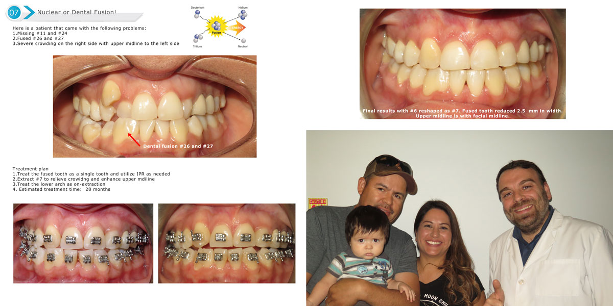 extreme orthodontic case sugar land orthodontist near me