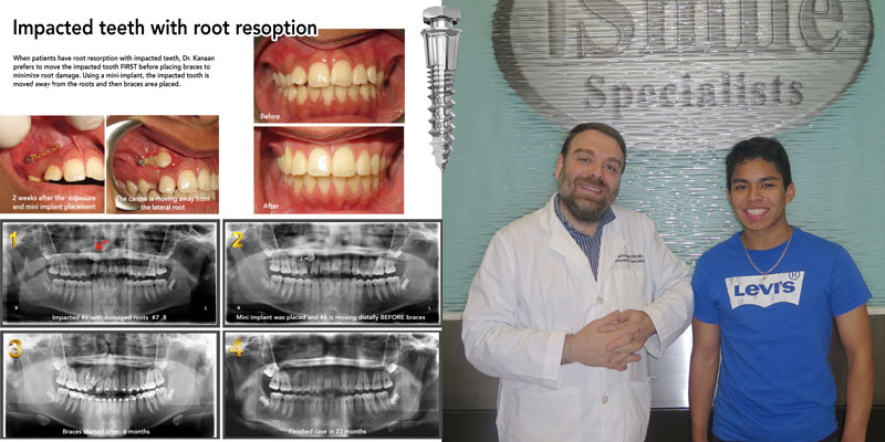 impacted teeth correction with mini implants 
