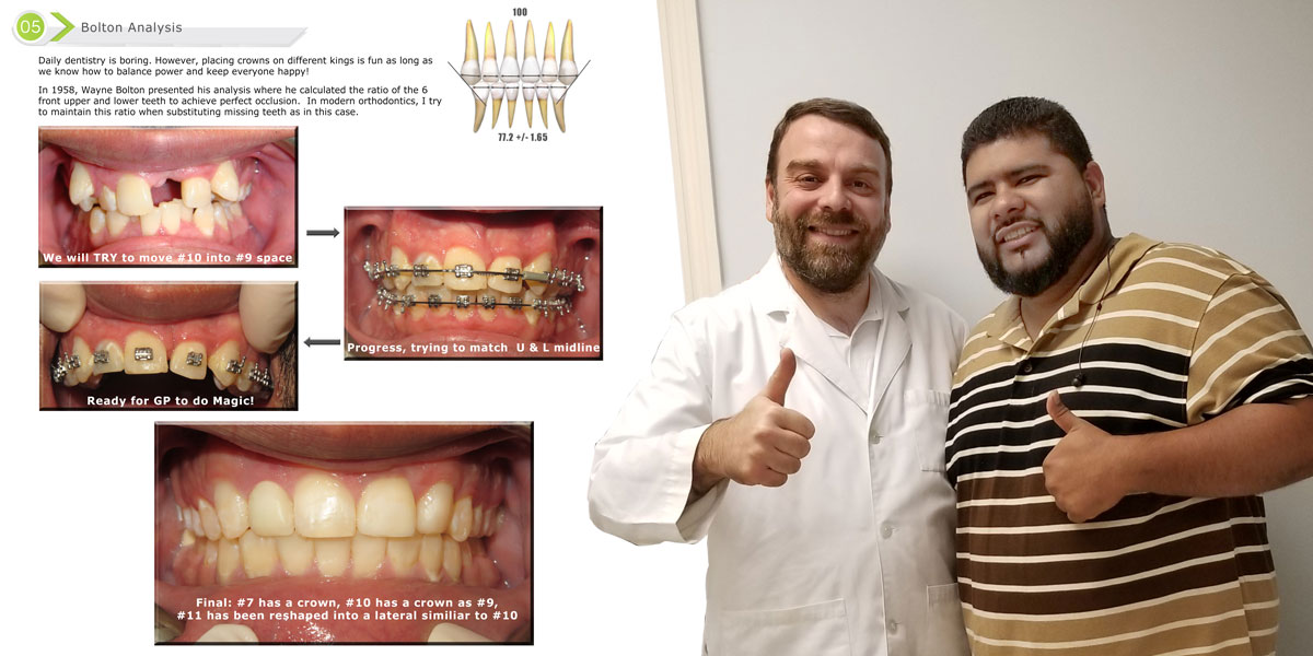 complex orthodontic case treated by Dr. Wael kanaan