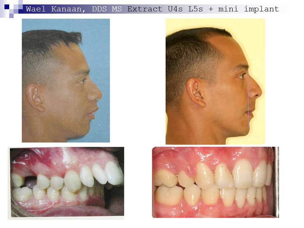 overbite correction without surgery