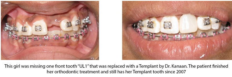Temporary dental implant for growing children
