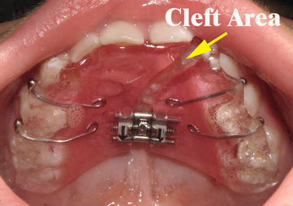 removable expander for early treatment CLP