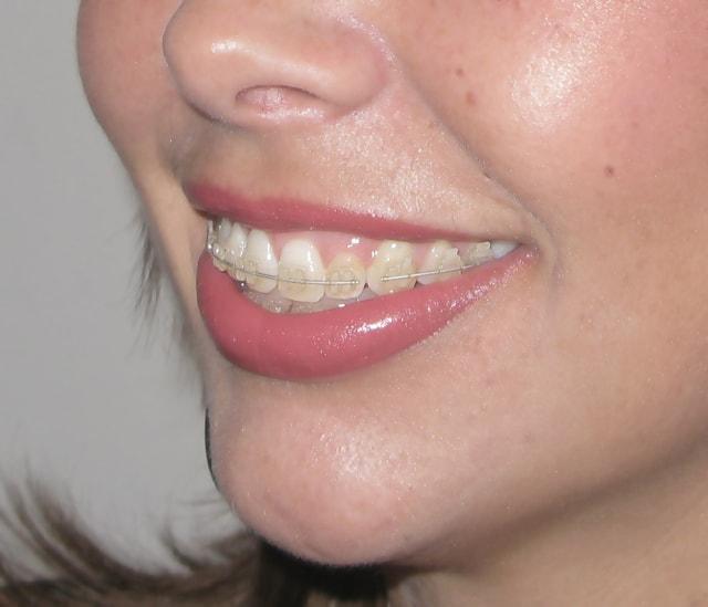 clear braces