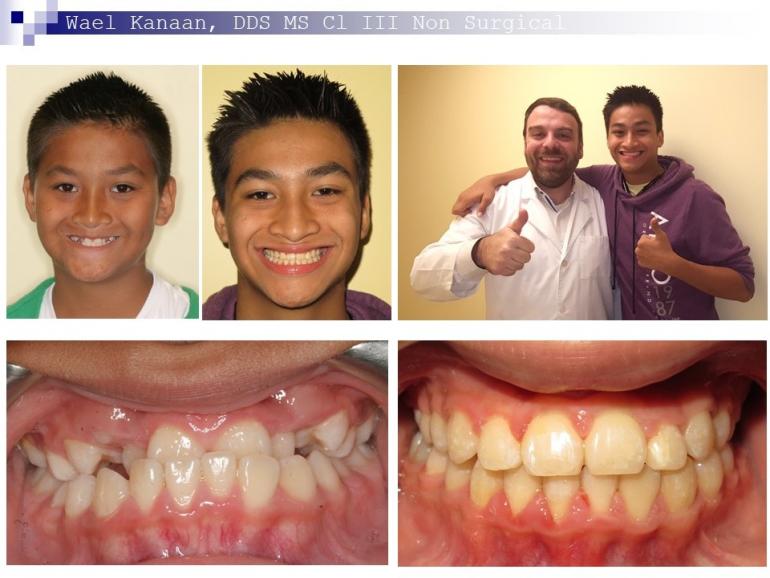 Underbite correction without surgery in Sugar Land and Houston