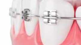 3D Image of braces