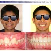 complex orthodontic case 11