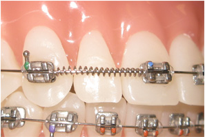 What do I need to know about metal braces? | iSmile Specialists
