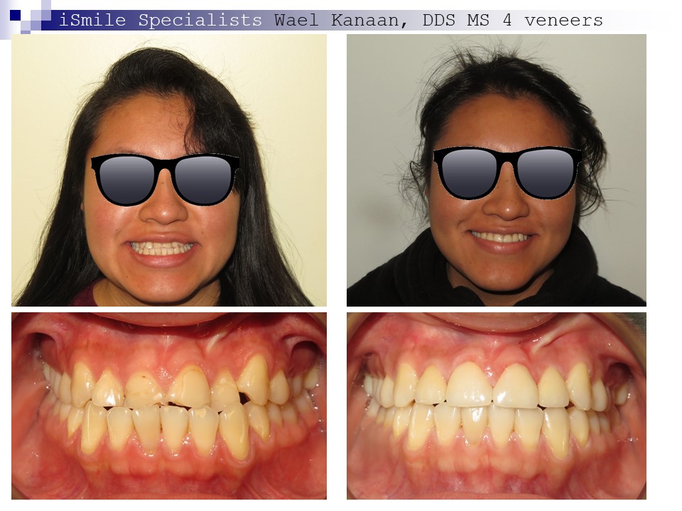 Complex Orthodontic Cases iSmile Specialists
