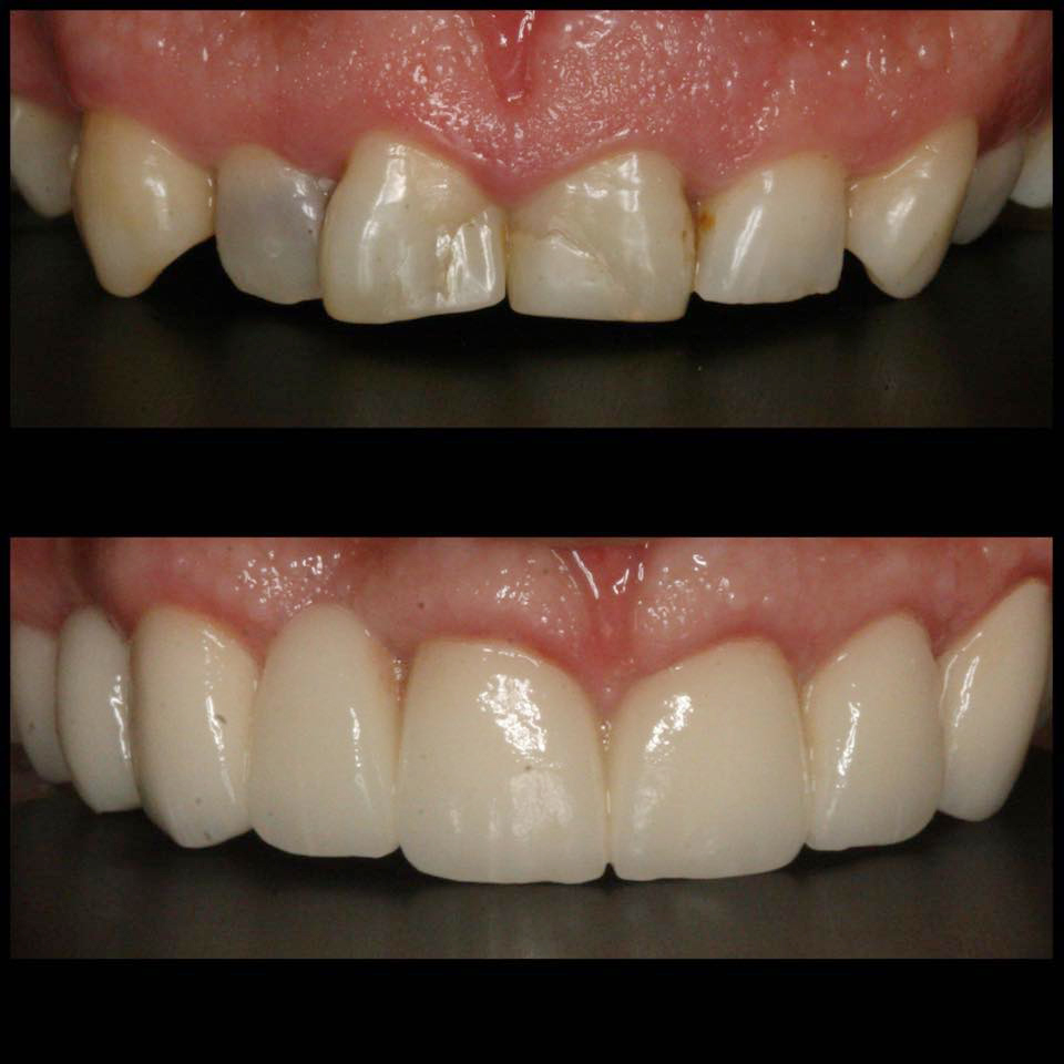 Affordable Dental Veneers In Houston Porcelain Veneers Cost