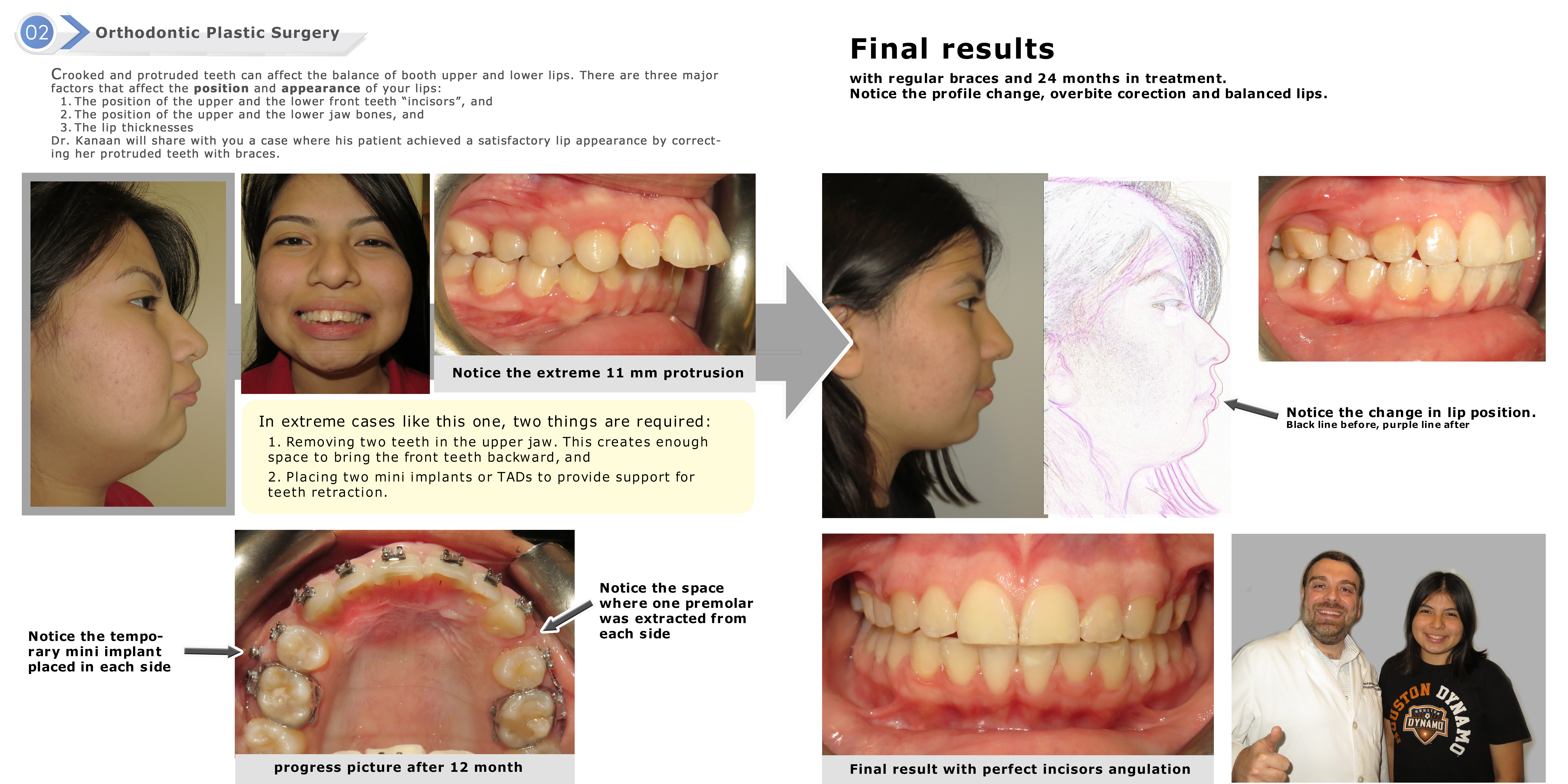 Overbite correction with TADs