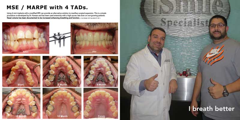 MARPE orthodontics with TADs Kanaan Ortho