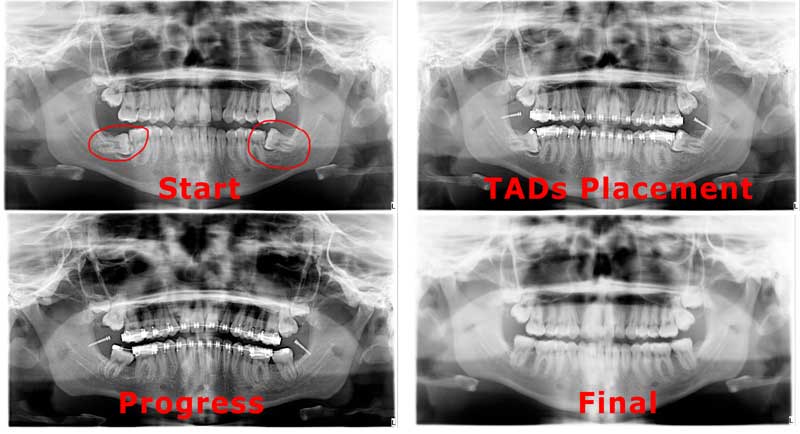 Uprighting tilted molars with TADs