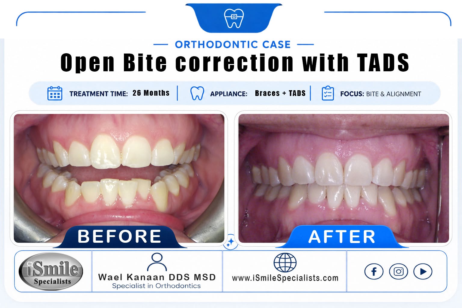 Open bite treatment with TADs before treatment