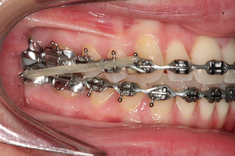 Rubber bands to correct the overbite
