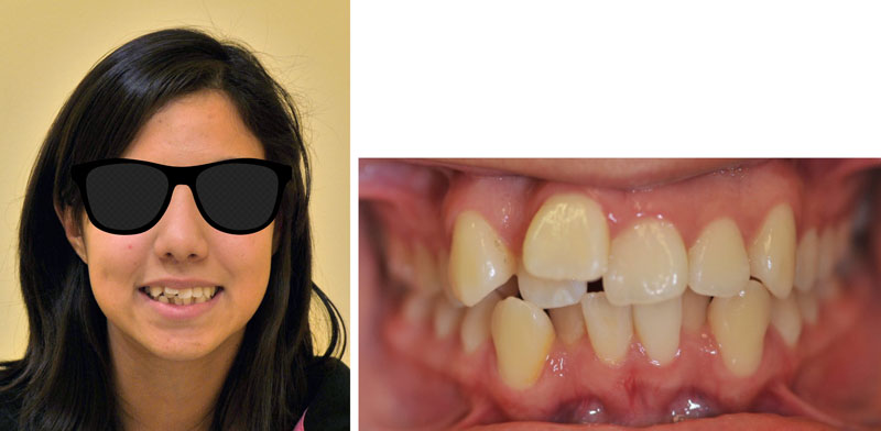 Crowded case that was treated with extracting upper incisors