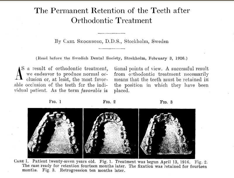 permanent retainer