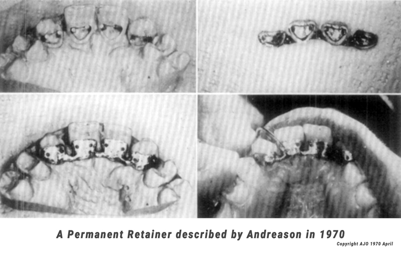 Permanent Retainer in Houston