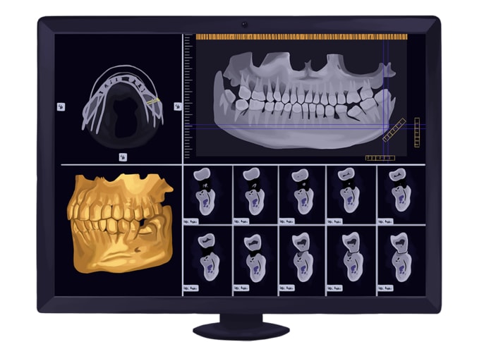 x-ray for dental implants
