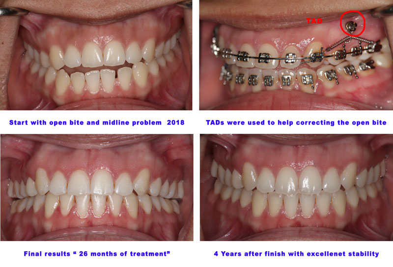 Open bite correction with TADs Houston Sugar Land