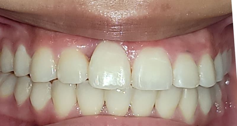 Trauma tooth follow up after orthodontic correction