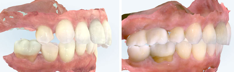 Before and After Orthodontic Treatment. Notice how LR6 is more upright