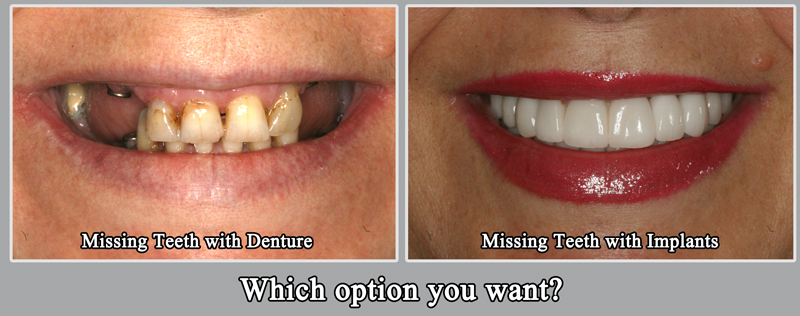 Implant before and After Houston