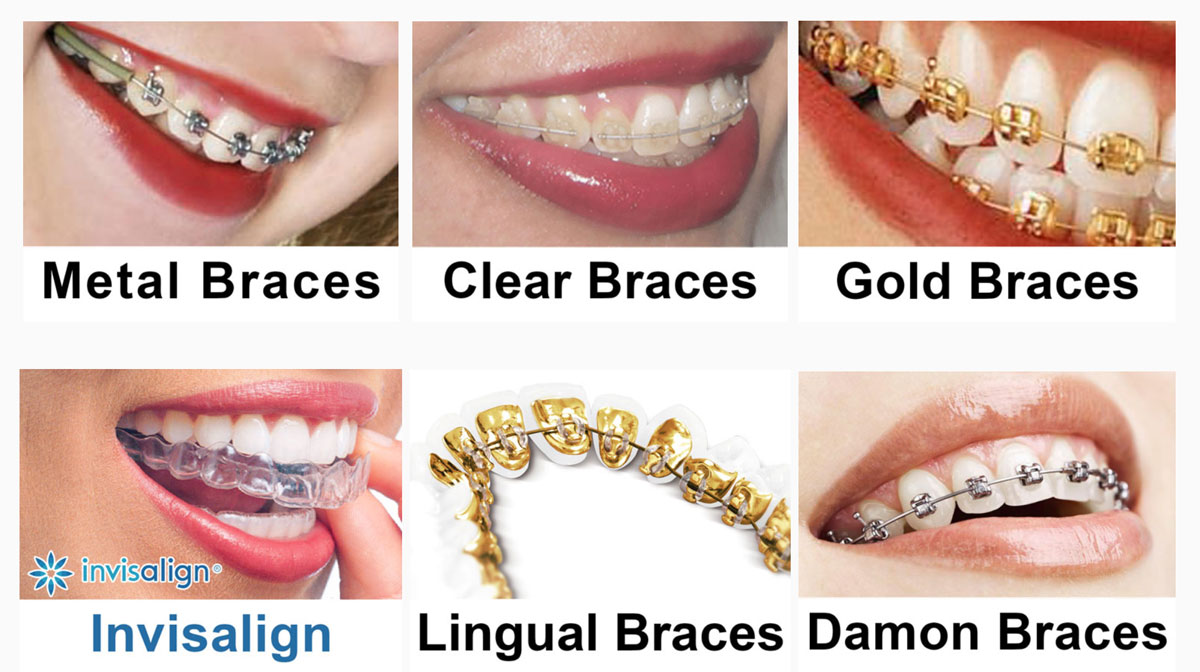 Braces Types