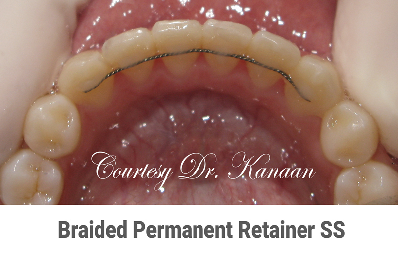 Permanent retainer Houston