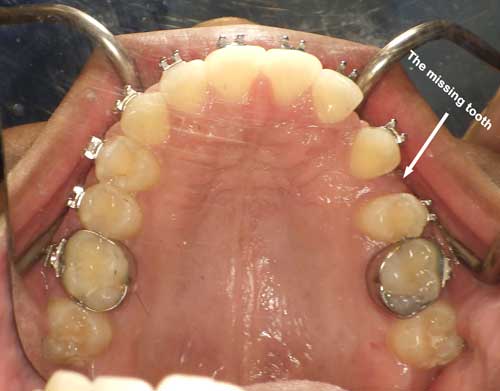 Imlpant orthodontic houston sugar Land