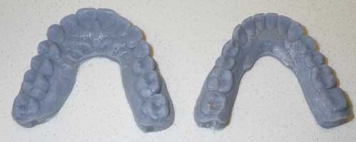 3D dental printed models for patients