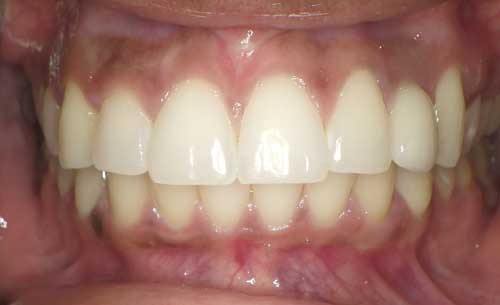 Excellent implant placement in Houston