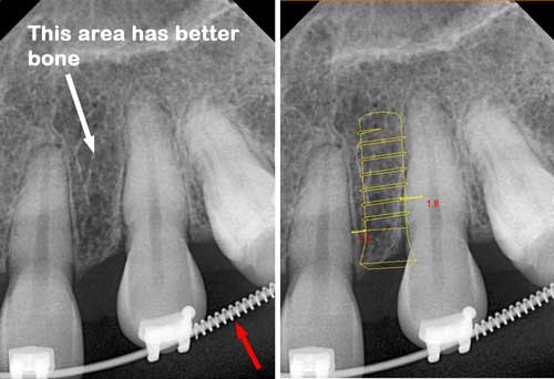 Implant placement with ortho treatment in Houston