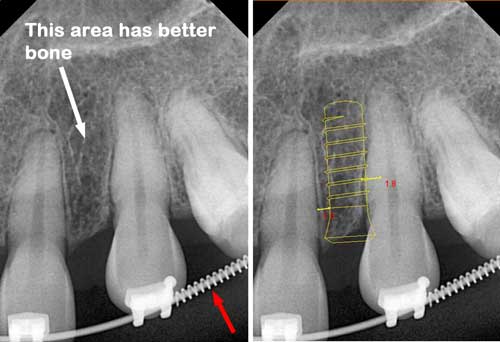 Implant placement with ortho treatment in Houston