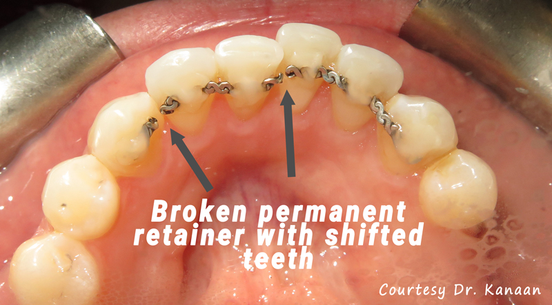 broken permanent retainer