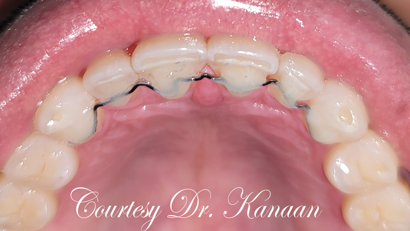 Permanent retainer Houston