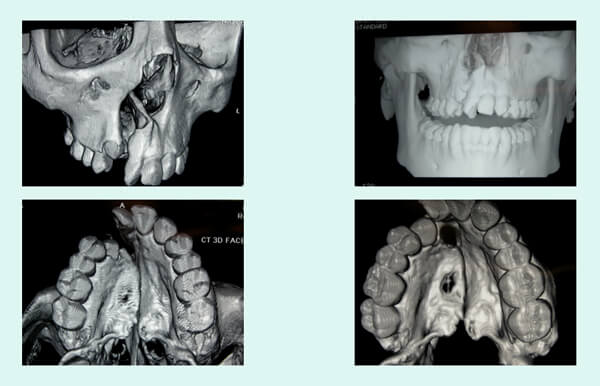 CT scan for the cleft area