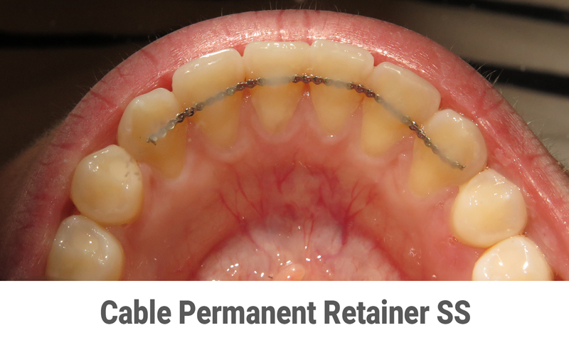 Permanent retainer Houston