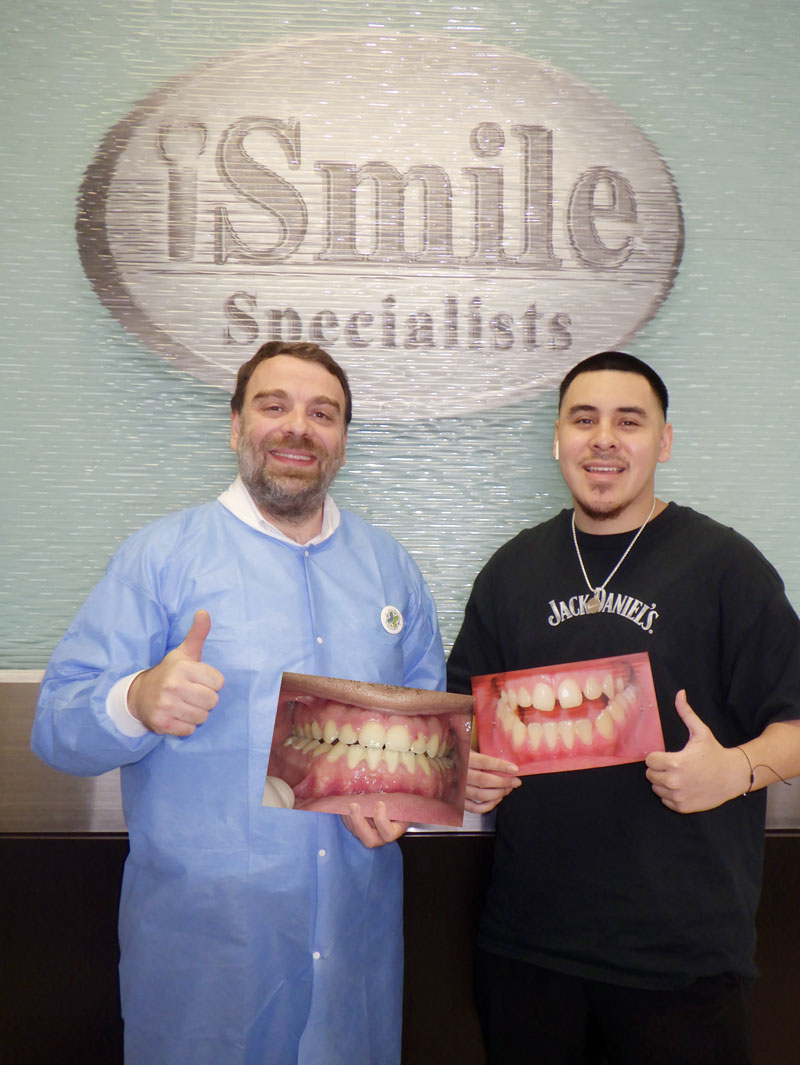 Underbite treatment without surgey in Sugar Land using TADs mini implants