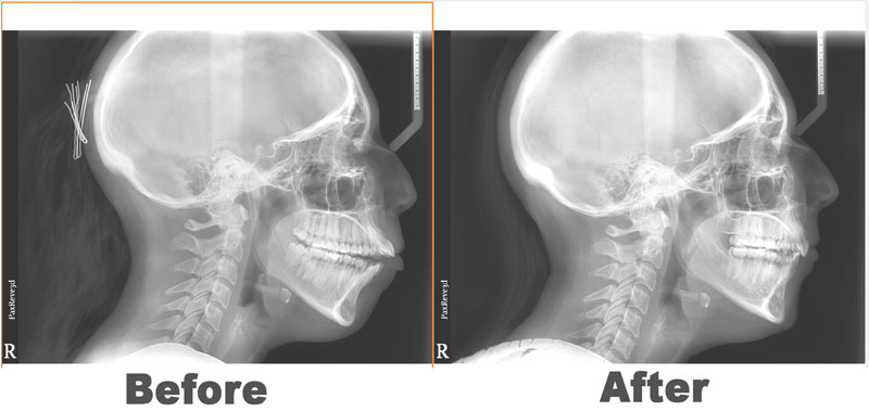 Open bite correction with TADs houston