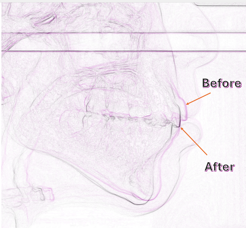 Cephalometric Analysis of her smile change