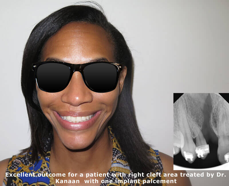 cleft lip surgical correction before and after