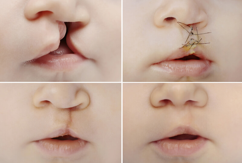 Early surgical correction of the lip is very important.