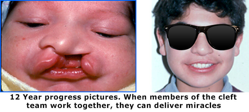 Cleft lip and Palate CLP before and After Houston