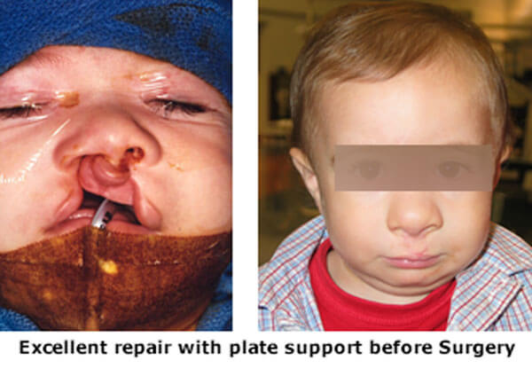 cleft lip plate effect