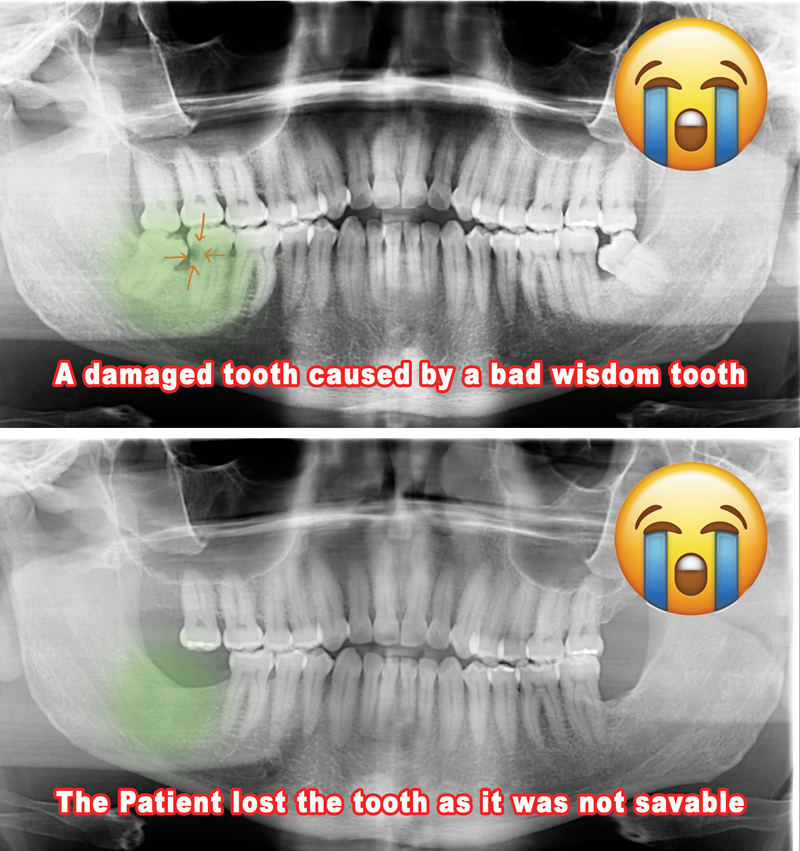 Wisdom teeth removal sugar land