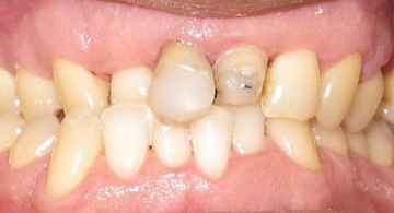 Complex Orthodontic Case 1