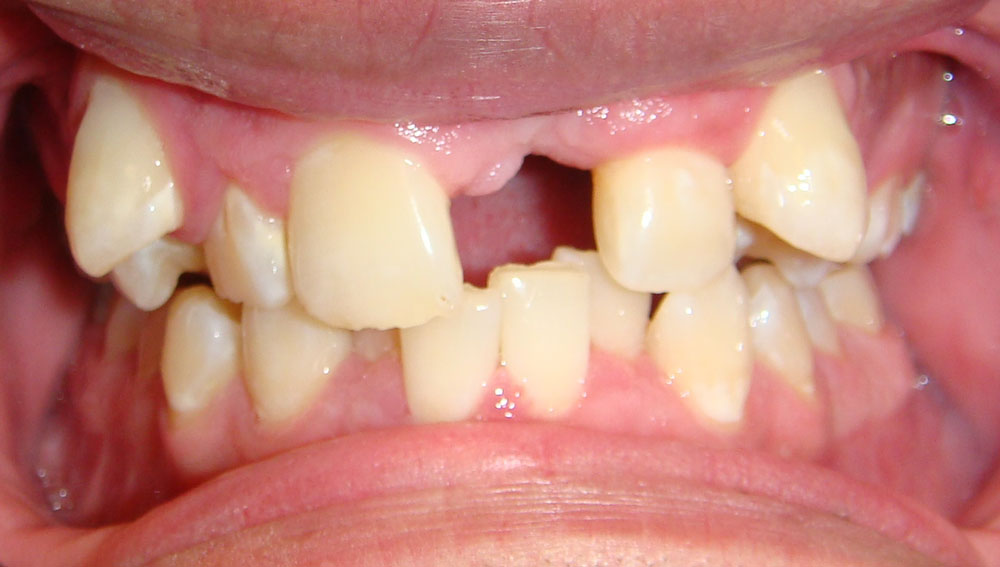 Complex Orthodontic case