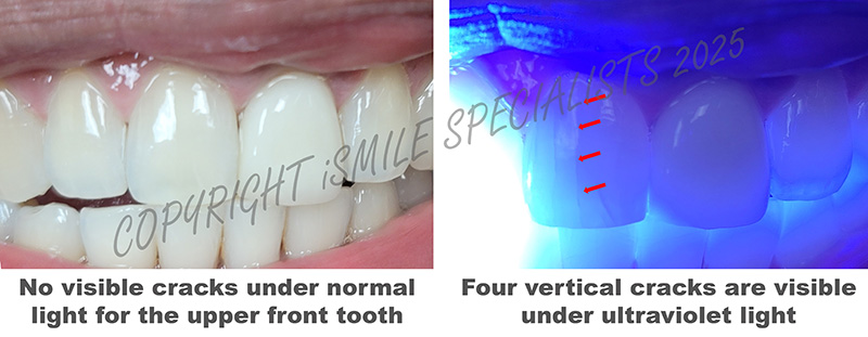 cracked tooth syndrome