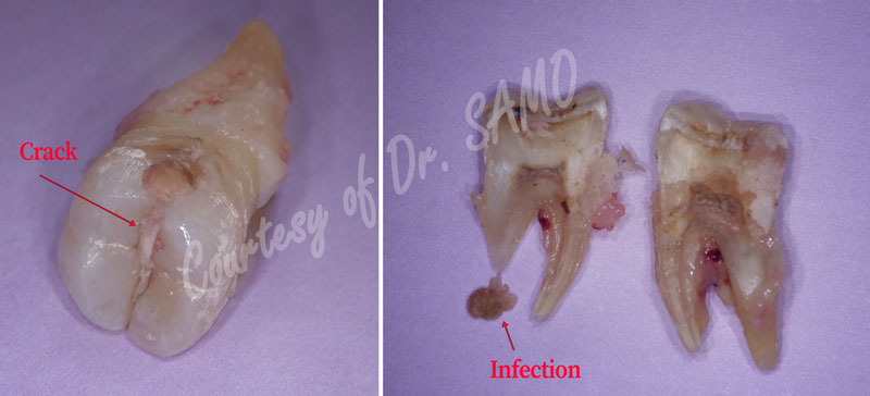 Cracked tooth syndrome treatment in Houston